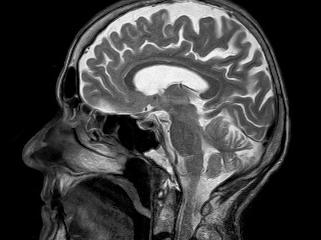 Нейросеть научилась определять IQ человека по МРТ
