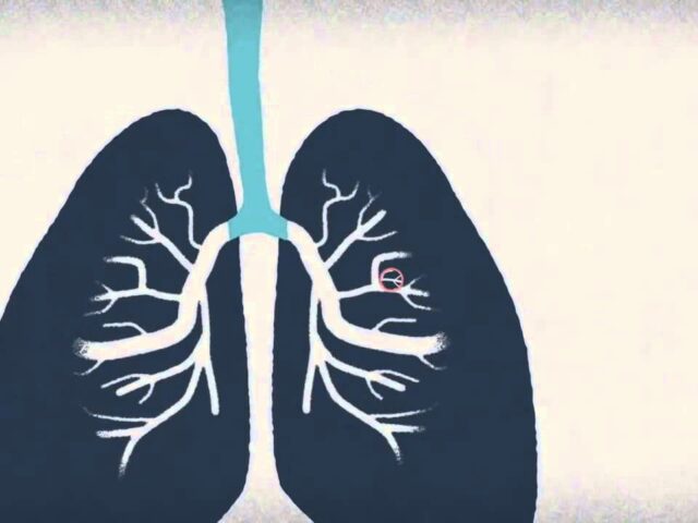 Ученые придумали крохотного робота для обследования легких. Он проникает в самые маленькие бронхи