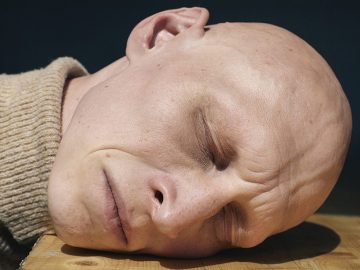 Андрогенная алопеция. Перспективные методы борьбы с облысением