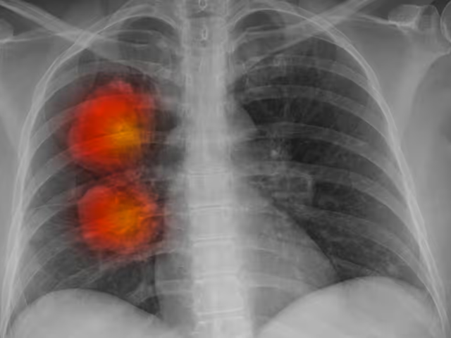 Медики разработали новый метод лечения агрессивных видов рака