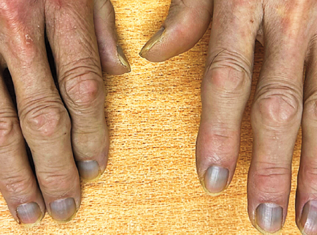 Житель Гонконга проглотил серебро и заболел редкой болезнью