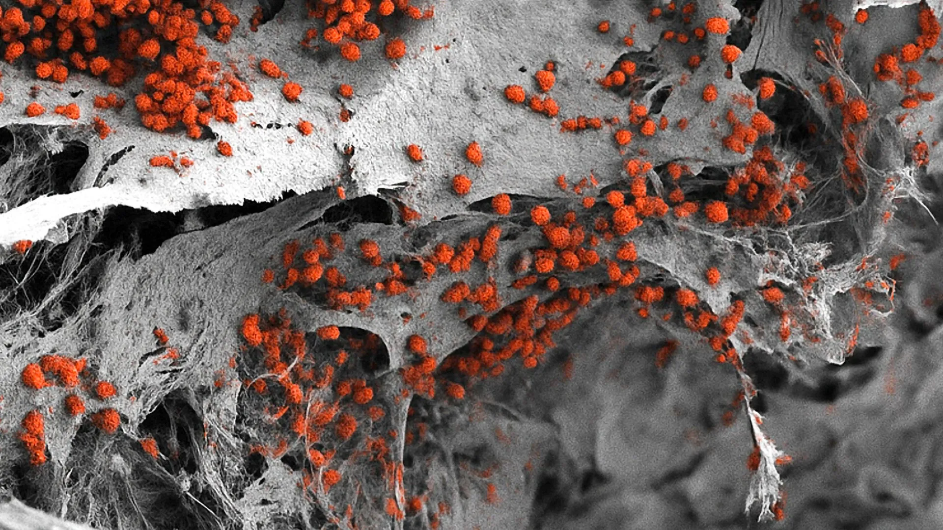 лечение рака крови, костный мозг исследование