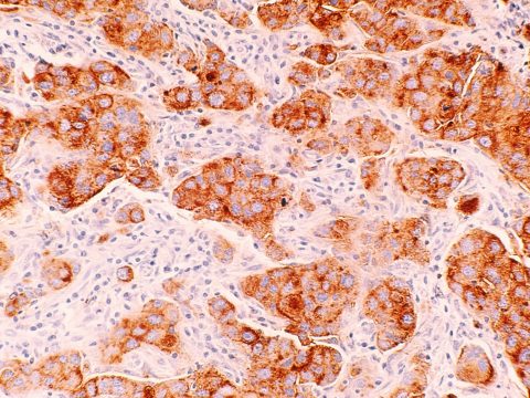 Исследование: особенность раковых клеток, ответственных за распространение метастазов