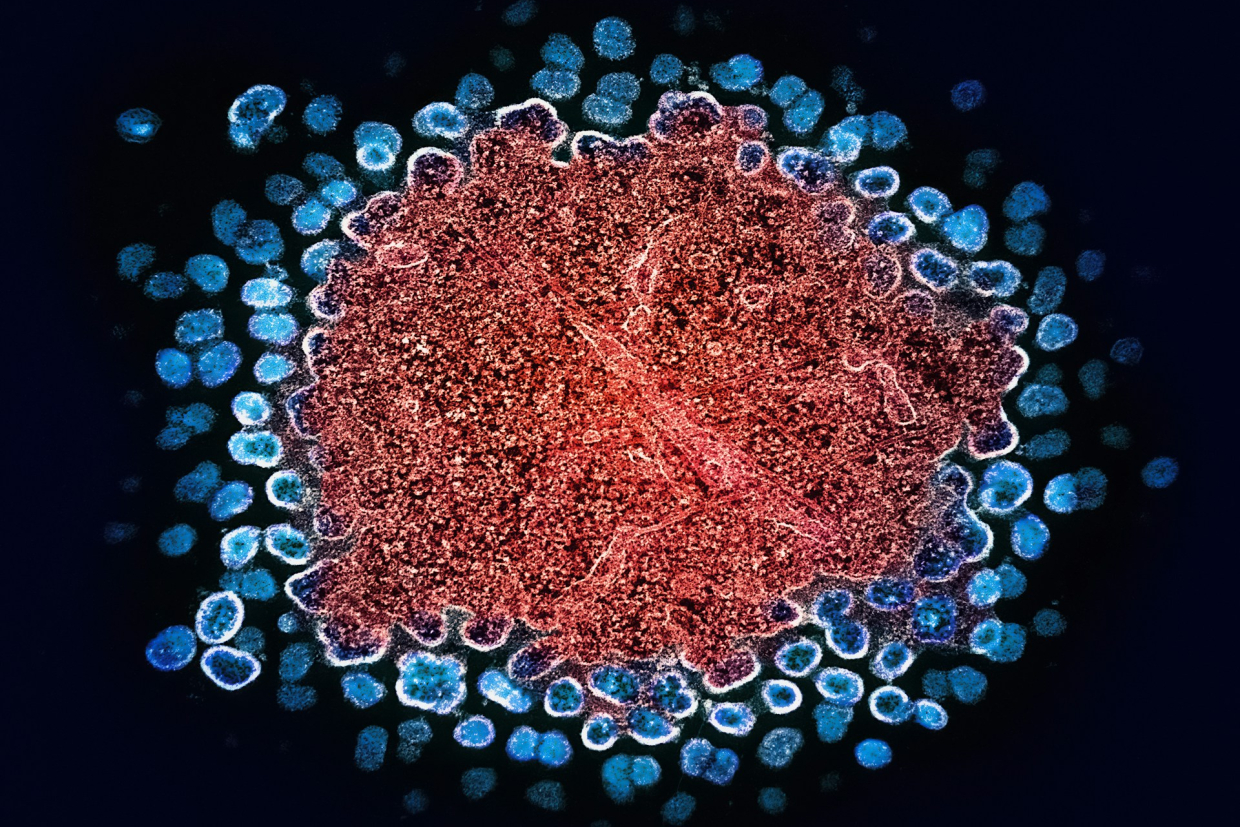 Норвежец полностью излечился от ВИЧ благодаря пересадке стволовых клеток брата