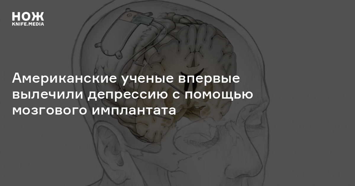 Мозговые импланты презентация