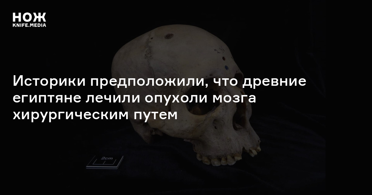 Историки предположили, что древние египтяне лечили опухоли мозга ...