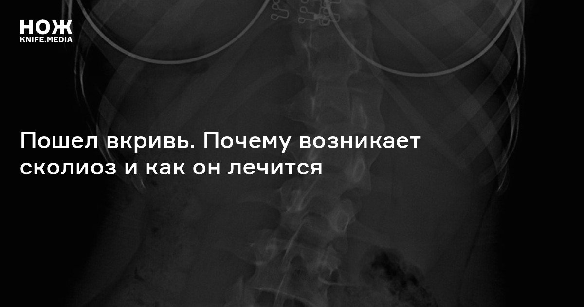 Сколиоз — Нож