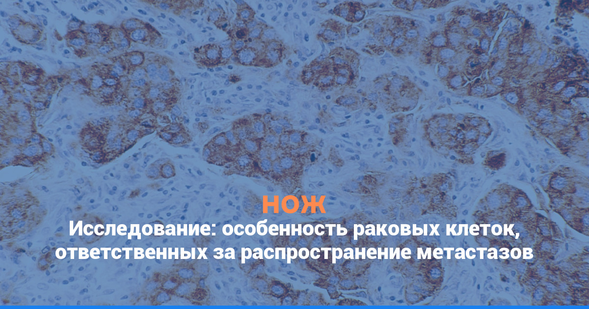 Исследование: особенность раковых клеток, ответственных за распространение метастазов
