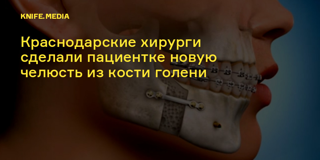 Краснодарские хирурги сделали пациентке новую челюсть из кости голени — Нож